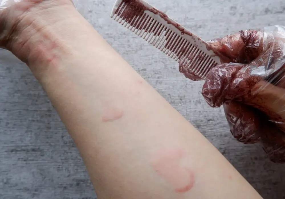 Alergia na farby do włosów objawy – jak uniknąć groźnych reakcji