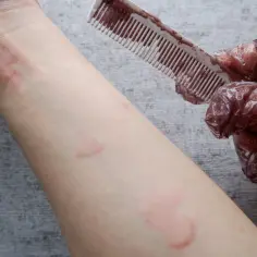 Alergia na farby do włosów objawy – jak uniknąć groźnych reakcji