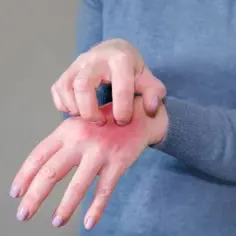 Czy manicure tytanowy uczula? Objawy i jak ich uniknąć