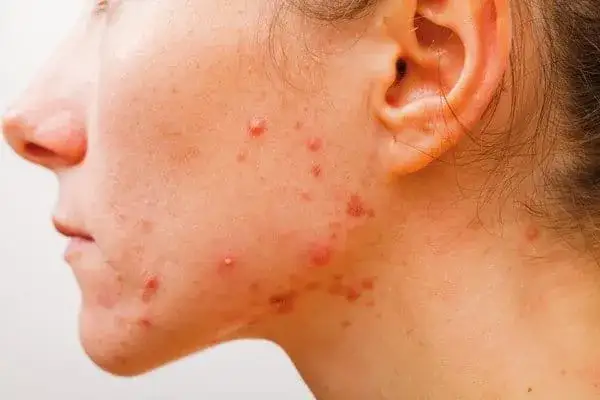 Zdjęcie Czy krem Nivea jest dobry na trądzik? Sprawdź, zanim użyjesz